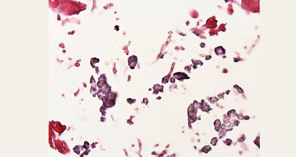 Diagnosis of Aspergillosis