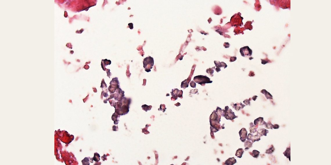 Diagnosis of Aspergillosis