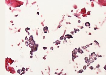 Diagnosis of Aspergillosis