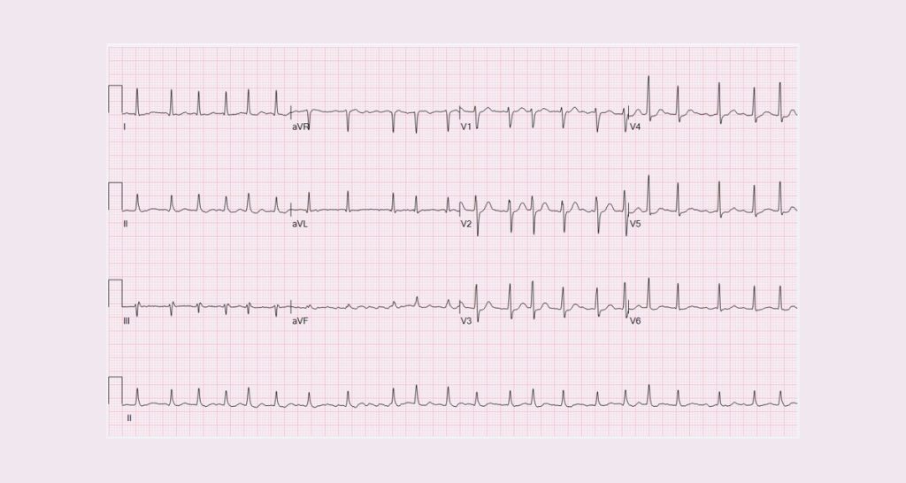 Diagnosis of Atrial Fibrillation