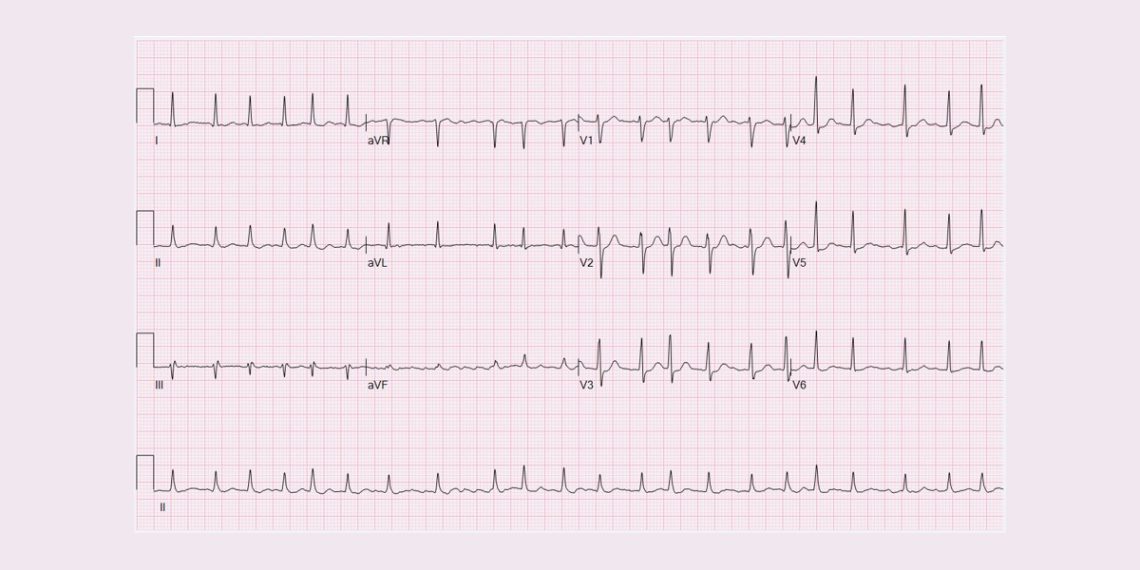 Diagnosis of Atrial Fibrillation