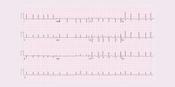 Diagnosis of Atrial Fibrillation