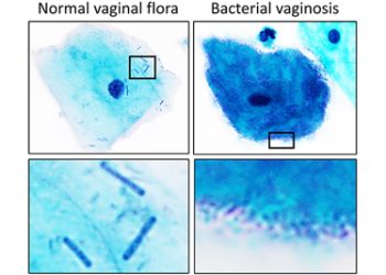 Microscopic comparison of normal vaginal flora and bacterial vaginosis showing clue cells and bacteria.
