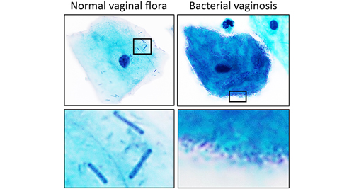 Microscopic comparison of normal vaginal flora and bacterial vaginosis showing clue cells and bacteria.