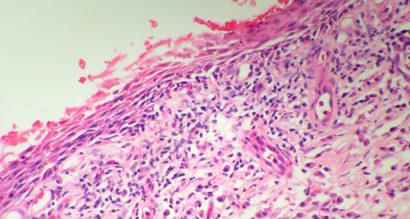 Diagnosis of Balanitis