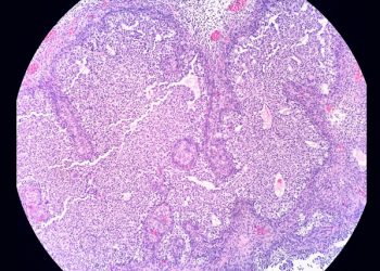 Microscopic histology slide showing glandular tissue used for diagnosing Bartholin’s cyst.