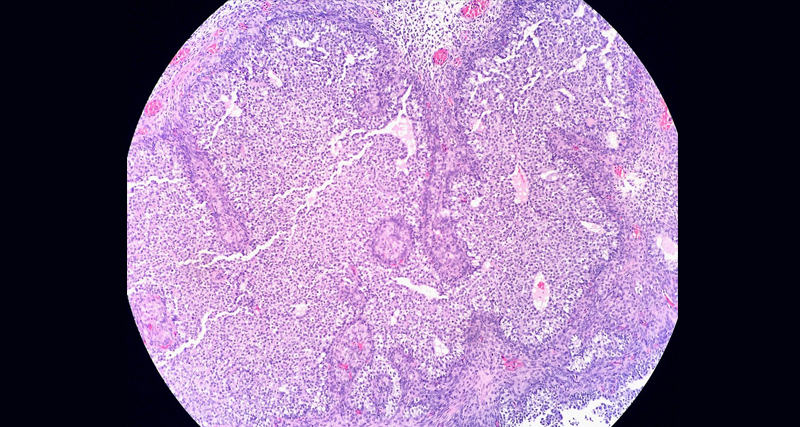 Microscopic histology slide showing glandular tissue used for diagnosing Bartholin’s cyst.