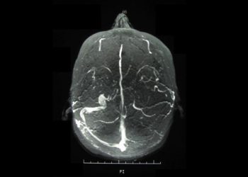 MRI brain scan showing neurological involvement associated with Behçet’s disease.