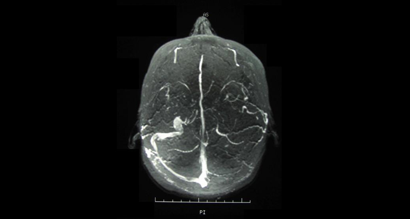 MRI brain scan showing neurological involvement associated with Behçet’s disease.