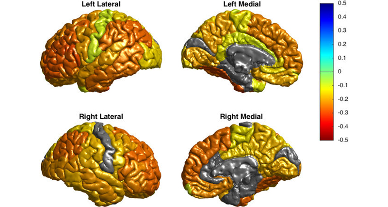 Colour-coded brain scans showing structural differences in the brain, related to the diagnosis of bipolar disorder.