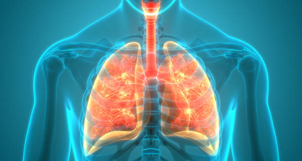 3D illustration of inflamed lungs showing bronchitis diagnosis