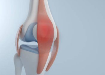 Medical illustration of knee joint highlighting bursitis inflammatio