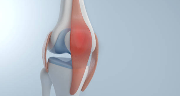 Medical illustration of knee joint highlighting bursitis inflammatio