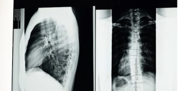 X-ray images of a human chest and spine used for cardiovascular diagnosis