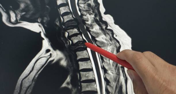 Doctor pointing at cervical spine MRI scan showing spondylosis