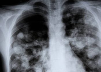 Chest X-ray showing signs of lung infection
