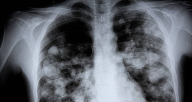 Chest X-ray showing signs of lung infection