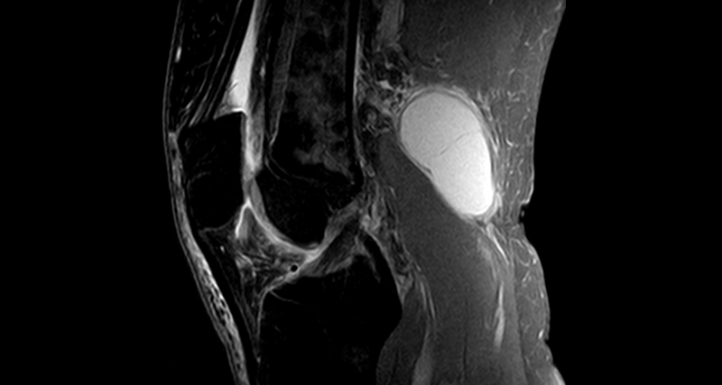 MRI scan showing a fluid-filled Baker’s cyst behind the knee joint, confirming diagnosis through medical imaging.