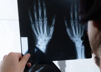Doctor reviewing X-ray of hands for broken finger diagnosis