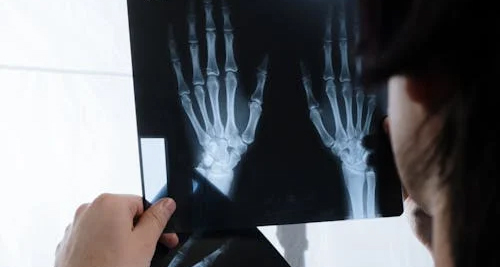 Doctor reviewing X-ray of hands for broken finger diagnosis