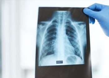 Doctor holding up chest X-ray to diagnose rib fracture