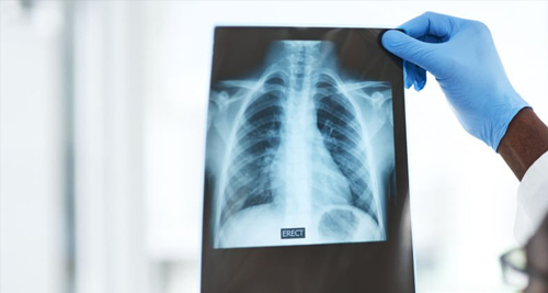 Doctor holding up chest X-ray to diagnose rib fracture