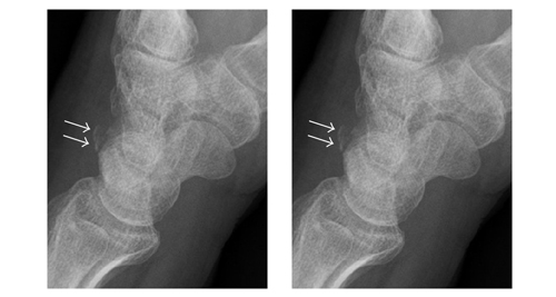 X-ray image comparison showing coccyx fracture and alignment irregularities