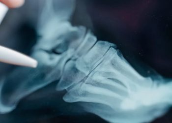 X-ray of a foot showing a suspected broken toe