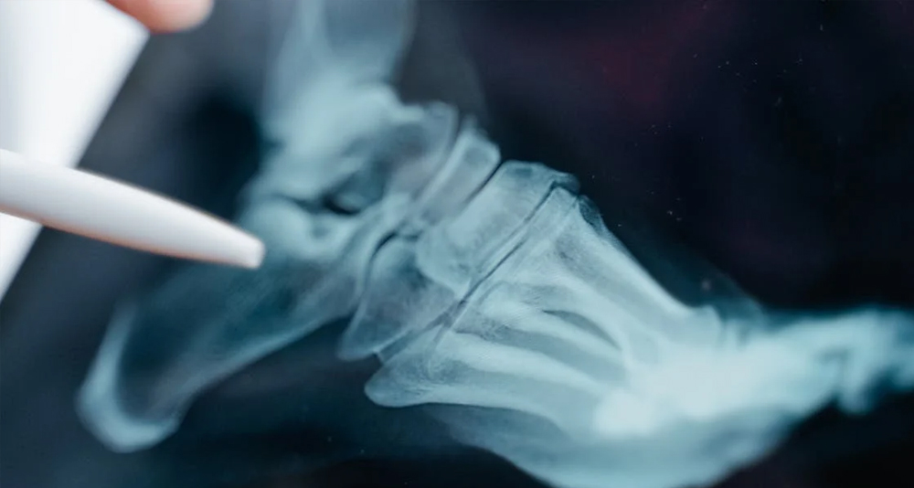 X-ray of a foot showing a suspected broken toe