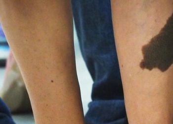 Dark pigmented birthmark on the back of a person's leg, highlighting a skin condition that may require medical evaluation.
