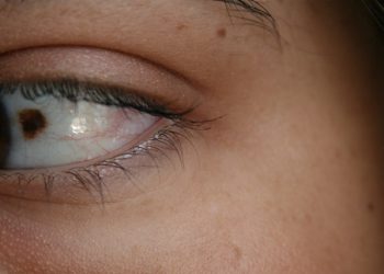 Close-up of an eye with a visible birthmark on the sclera, highlighting the personal and emotional aspects of facial birthmarks.