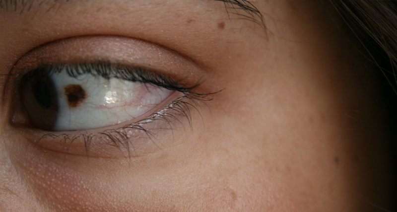 Close-up of an eye with a visible birthmark on the sclera, highlighting the personal and emotional aspects of facial birthmarks.