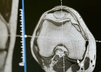Living Through Loss with Brain Death