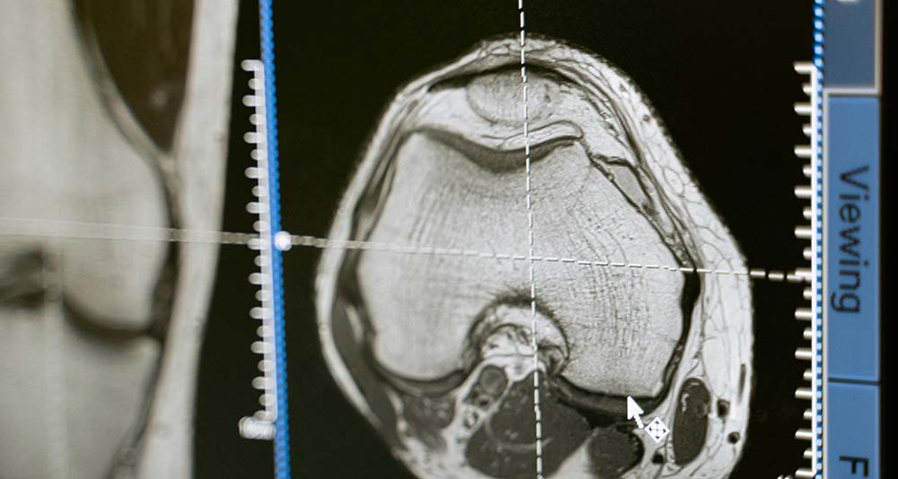 Living Through Loss with Brain Death