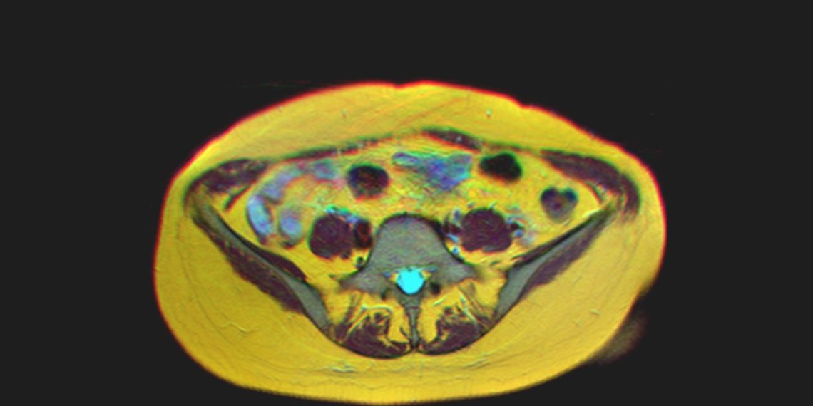 Living With Adenomyosis