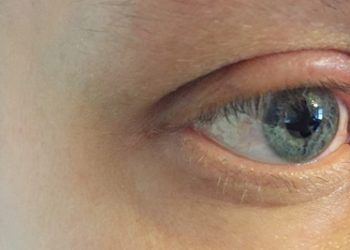 Close-up of an eye with visible redness and swelling around the eyelid, indicating symptoms of blepharitis.