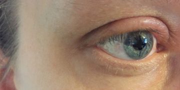 Close-up of an eye with visible redness and swelling around the eyelid, indicating symptoms of blepharitis.