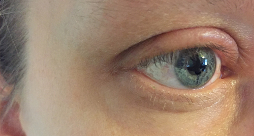 Close-up of an eye with visible redness and swelling around the eyelid, indicating symptoms of blepharitis.