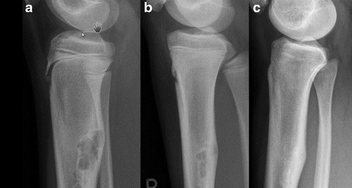 X-ray images showing the progression and treatment response of bone cancer in the leg.