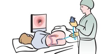 Medical illustration of a colonoscopy procedure for bowel cancer diagnosis and monitoring.