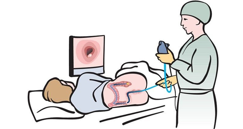 Medical illustration of a colonoscopy procedure for bowel cancer diagnosis and monitoring.