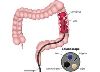 Diagram of colonoscopy detecting bowel polyps in the large intestine