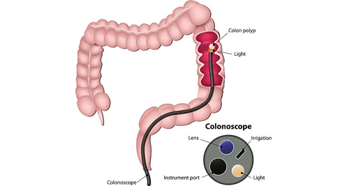 Diagram of colonoscopy detecting bowel polyps in the large intestine