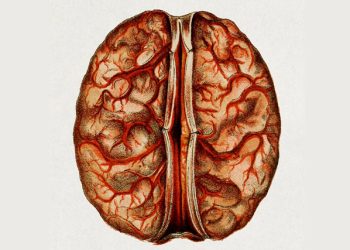 Medical illustration of a human brain affected by a brain abscess with visible vascular inflammation