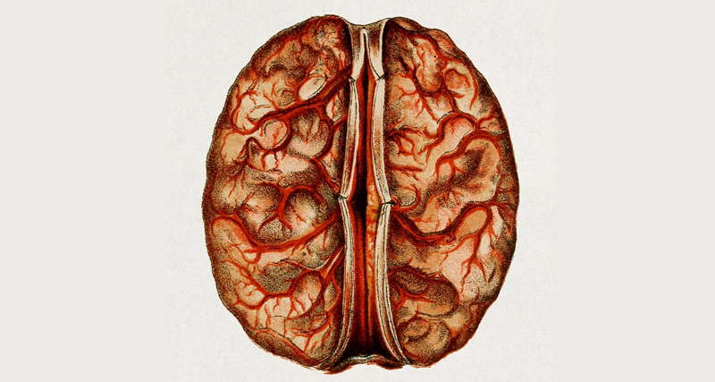 Medical illustration of a human brain affected by a brain abscess with visible vascular inflammation