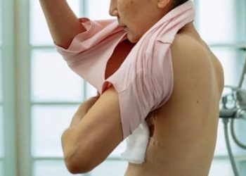 Living with Breast Cancer in Women