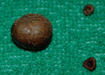 Bladder stones of varying sizes placed on a green medical cloth after removal.