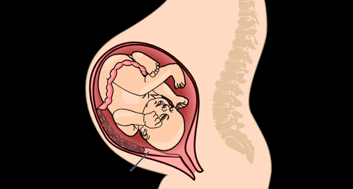 Reasons and Indications for Amniocentesis