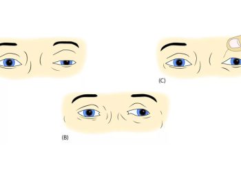Illustration showing eye and facial muscle symptoms during different stages of Bell’s palsy recovery, including eyelid weakness and patch use.