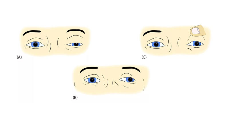 Illustration showing eye and facial muscle symptoms during different stages of Bell’s palsy recovery, including eyelid weakness and patch use.